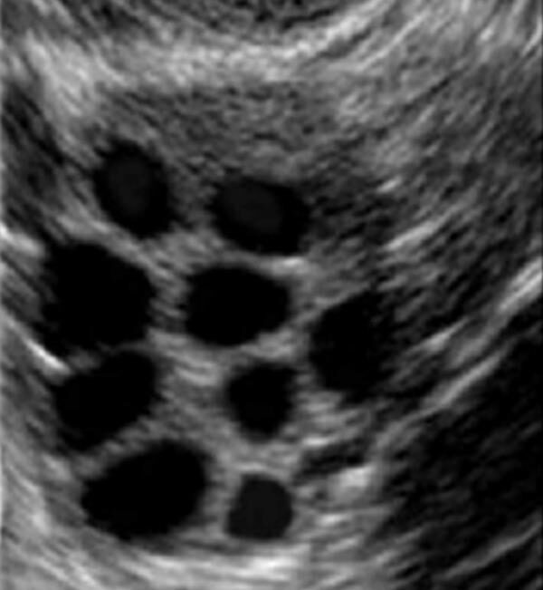 A Conversation with ChatGPT about Ovarian Follicles and Black Holes